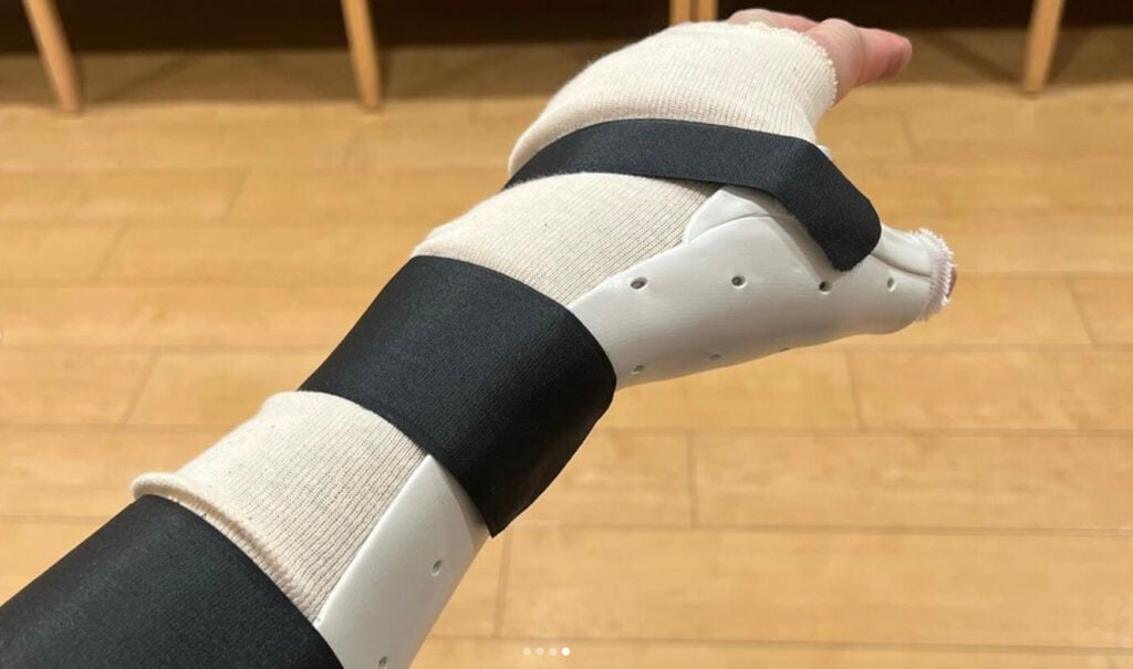 Alex Karwoski showing off his broken hand in a cast.